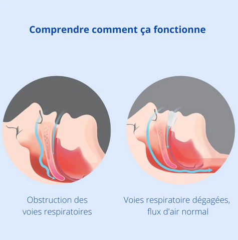 Anti-snoring oral appliance