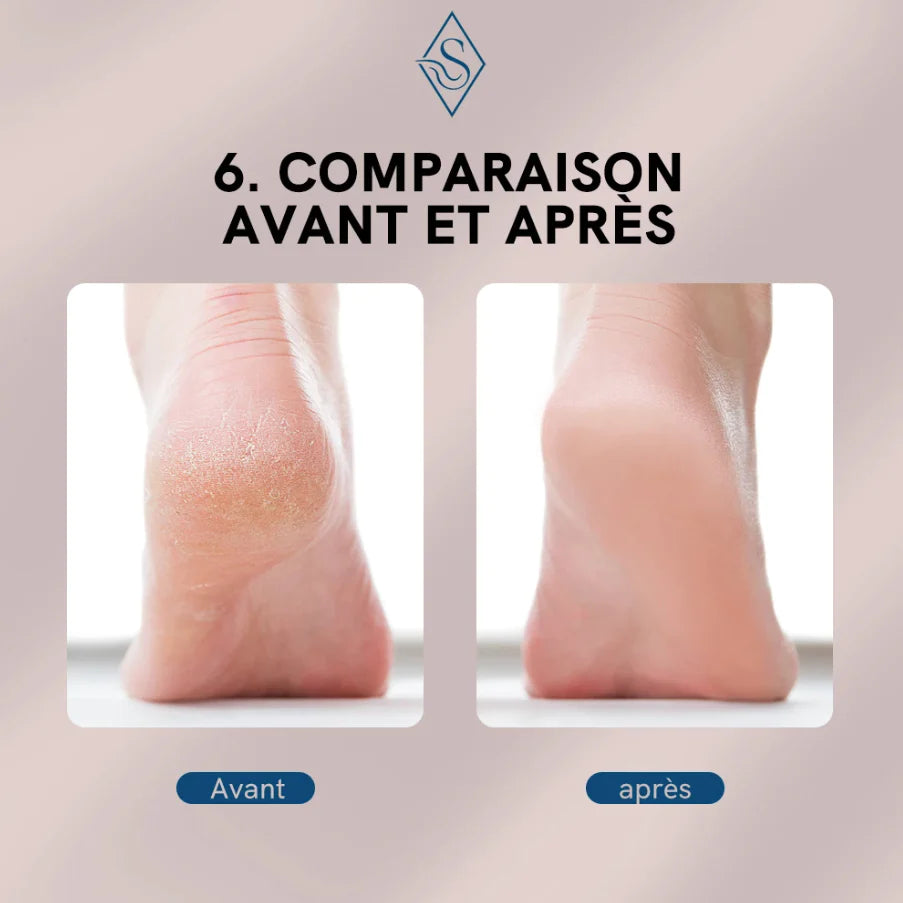 Electric callus remover for feet