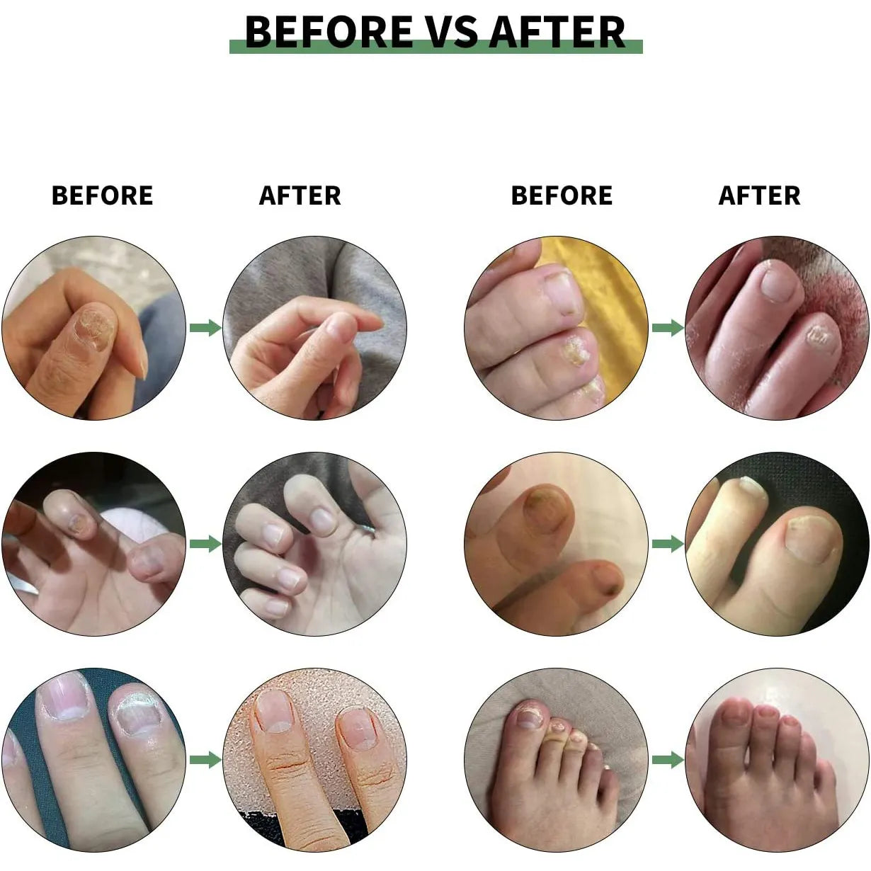 Solution Antifongique - Mycose Ongles - 1 ACHETÉ = 1 OFFERT