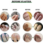 Solution Antifongique - Mycose Ongles - 1 ACHETÉ = 1 OFFERT
