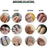 Solution Antifongique - Mycose Ongles - 1 ACHETÉ = 1 OFFERT