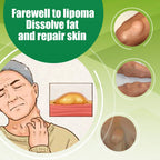 Soothing Cream for Lipomas and Nodules
