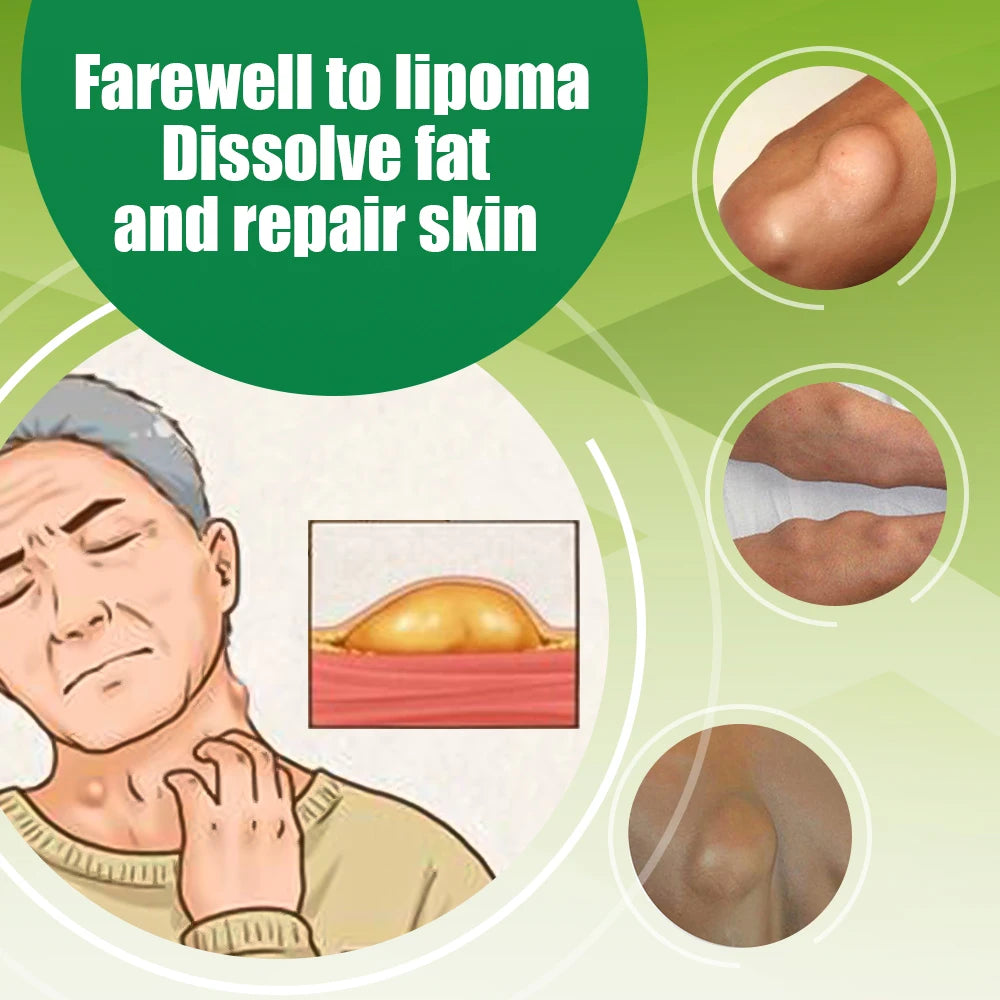 Soothing Cream for Lipomas and Nodules