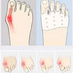 4x Silicone Forefoot Pads - Toe Alignment