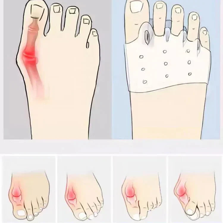 4x Silicone Forefoot Pads - Toe Alignment