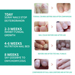 Solution Antifongique - Mycose Ongles - 1 ACHETÉ = 1 OFFERT
