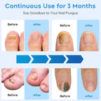 Rapid Laser Nail Treatment Device - FREE Repair Oil