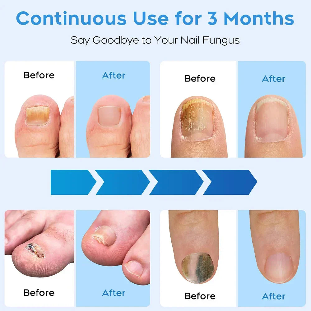 Rapid Laser Nail Treatment Device - FREE Repair Oil