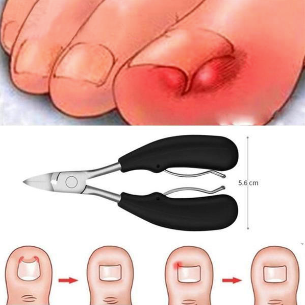 Ingrown Toenail Clipper Set - 4PCS