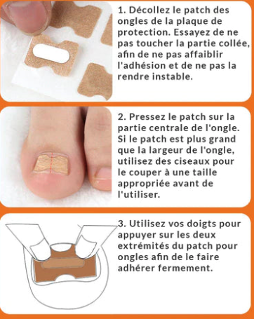 Patchs Correcteurs d'Ongles Incarnés