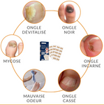 Patchs Correcteurs d'Ongles Incarnés