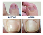 Patchs Correcteurs d'Ongles Incarnés